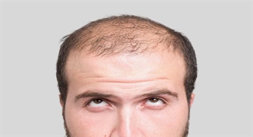 أنواع الصلع
