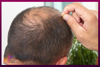 علاج تأخر نمو الشعر المزروع