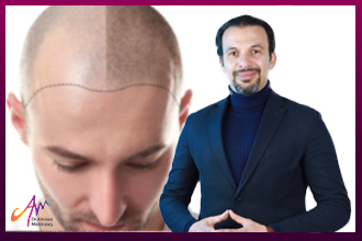 أفضل دكتور زراعة شعر في مصر