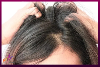 زراعة-الشعر-للنساء