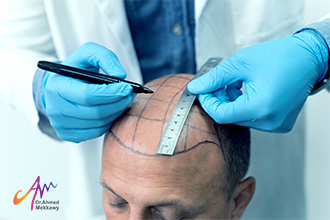 ما هي أفضل تقنية زراعة الشعر؟