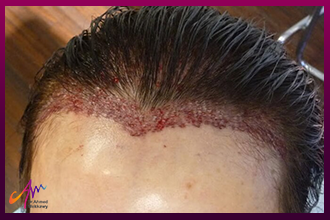 معلومات عن زراعة الشعر بالاقتطاف وزراعة الشعر للسيدات