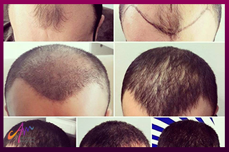 مراحل زراعة الشعر بالاقتطاف وإرشادات قبل وبعد الزراعة