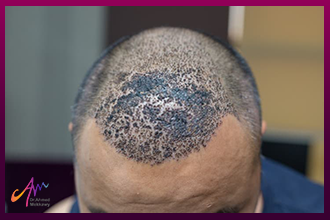 ما هي أعراض زراعة الشعر الجانبية وكيف يمكن الحد منها؟