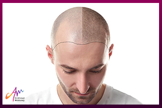 علاج صلع مقدمة الرأس عند الرجال عن طريق زراعة الشعر