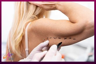 Slimming and Sculpting the Arms with Minimal Surgical Intervention