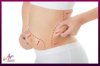 Tighten Sagging Skin After Sleeve Surgery to Get Rid of Excessive Skin