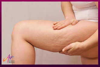 Ways to Reduce and Limit Cellulite