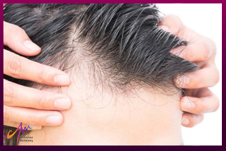 علاج فراغات الشعر عن طريق زراعة الشعر (إنفوجرافيك)