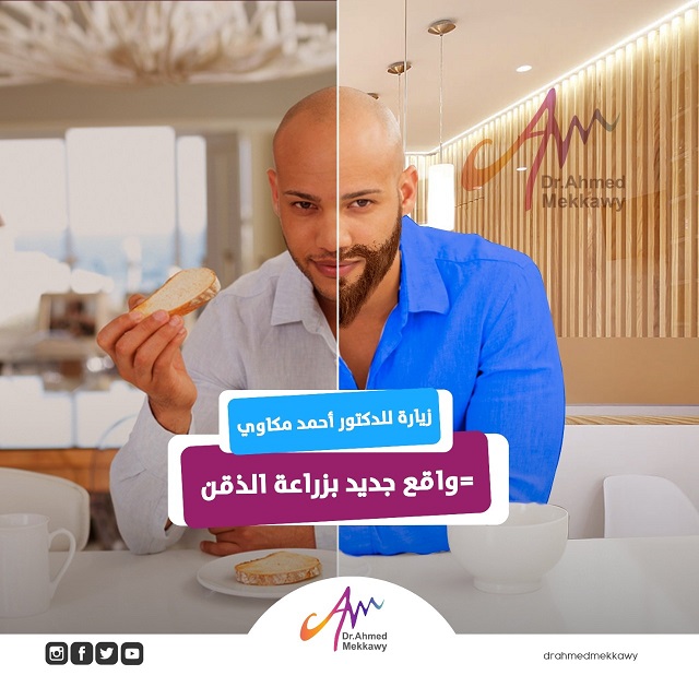 زراعة الذقن