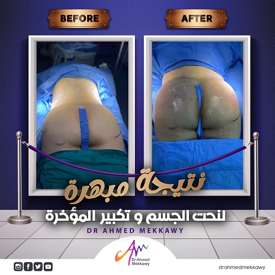 المؤخرة البرازيلية