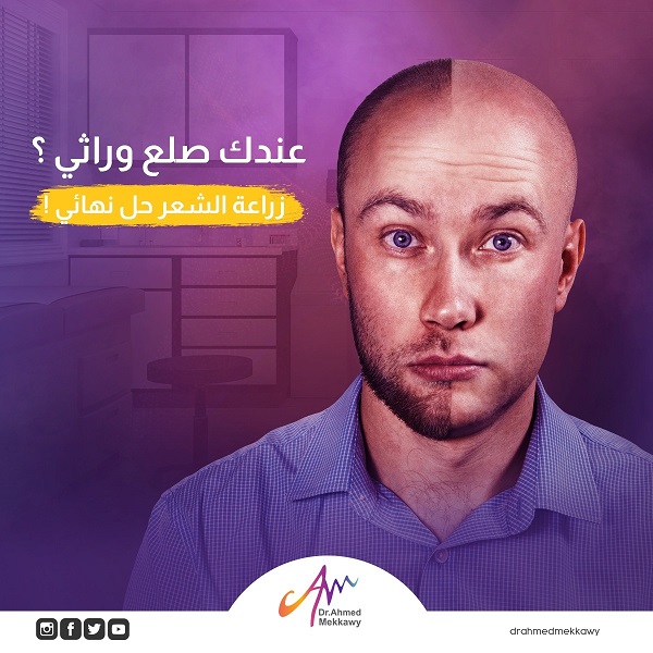 زراعة الشعر
