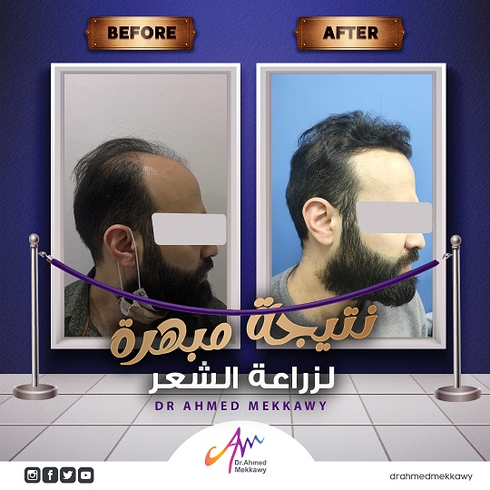 زراعة الشعر