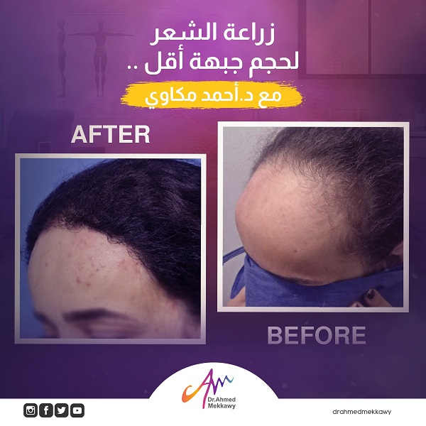 زراعة مقدمة الشعر