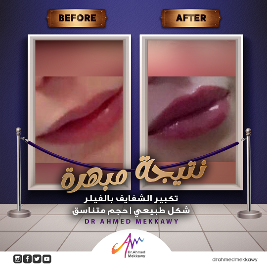 فيلر