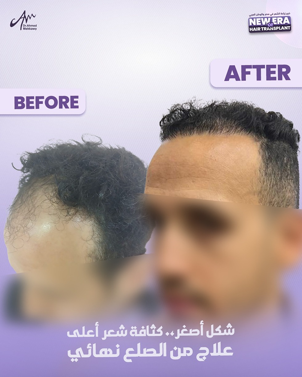 أحدث-طرق-زراعة-الشعر