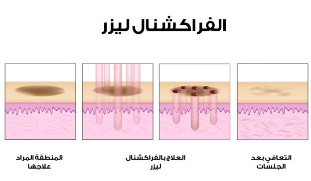 الفراكشنال-ليزر-لتجميل-البشرة