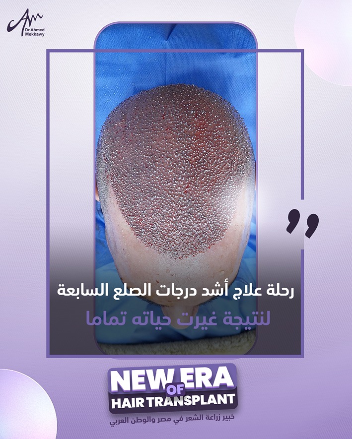زراعة-الشعر-في-مصر-درجة-سابعة