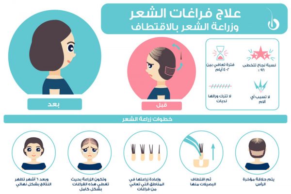 علاج-فراغات-الشعرعن-طريق-زراعة-الشعر