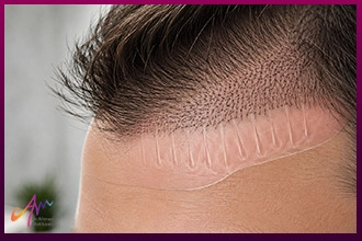 متى تثبت البصيلات بعد زراعة الشعر