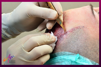 زراعة الشعر بالاقتطاف بالخطوات في المقال التالي