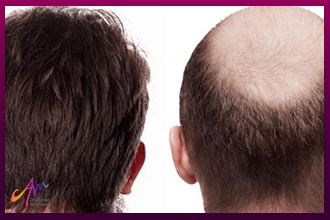 زراعة الشعر الطبيعي في مصر